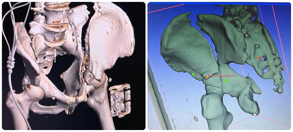 Prima intervenţie de fixare de bazin cu machetă 3D preoperator la Spitalul de Urgență Târgu Mureș