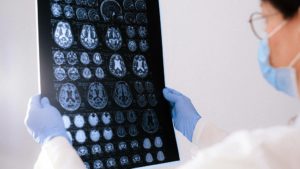 A fost descoperită o nouă genă, care provoacă boala Alzheimer